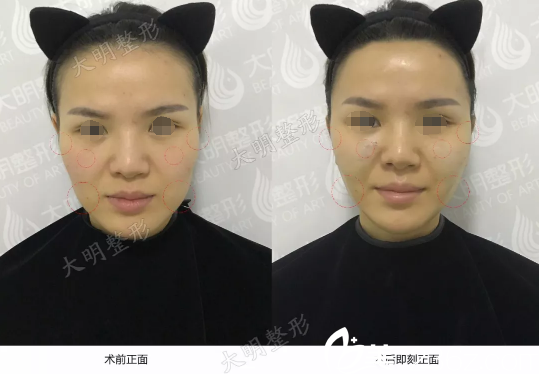 面部埋線提升+聯(lián)合除皺術(shù)前術(shù)后對比