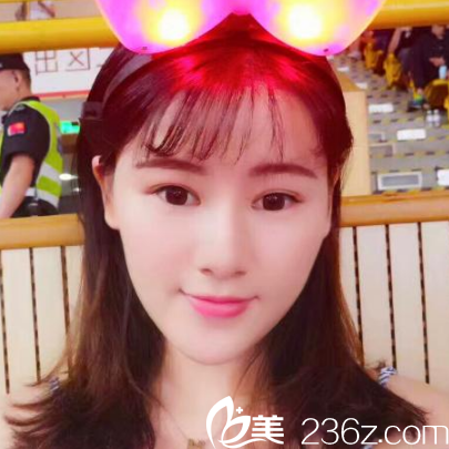 在<!--<i data=20240703-sp></i>-->整形醫(yī)院做完線雕埋線提升三個(gè)月了 在<!--<i data=20240703-sp></i>-->整形醫(yī)院做完線雕埋線提升三個(gè)月了