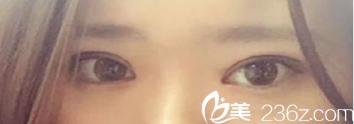 雙眼皮+內(nèi)開眼角術后效果