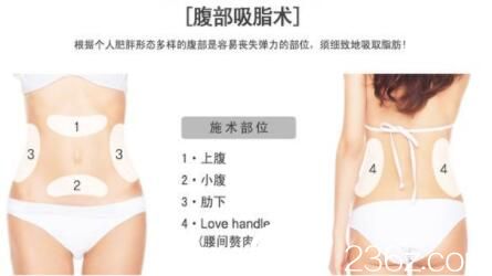 美萊美容醫(yī)院腰腹吸脂術 美萊美容醫(yī)院腰腹吸脂術