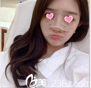 在北京畫美做隆鼻第3天樣子 在北京畫美做隆鼻第3天樣子