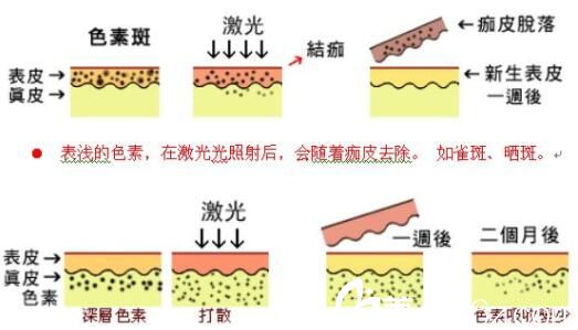美萊美容醫(yī)院俞滿昌激光祛斑