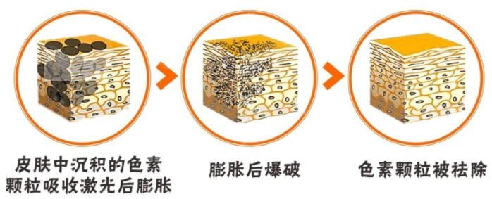 美萊美容醫(yī)院俞滿昌激光祛斑原理