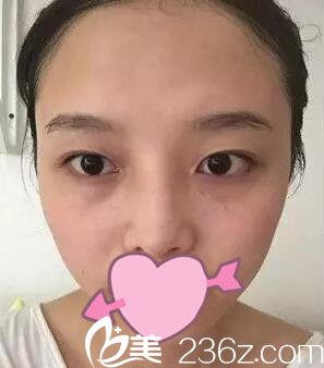 單眼皮術(shù)前照 單眼皮術(shù)前照