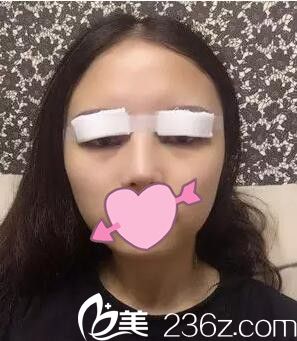 耿成虎做雙眼皮術(shù)后天 耿成虎做雙眼皮術(shù)后天