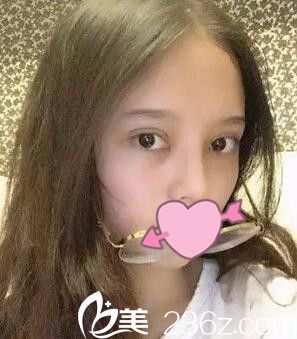 錦州斯美諾雙眼皮術(shù)后第三天 錦州斯美諾雙眼皮術(shù)后第三天