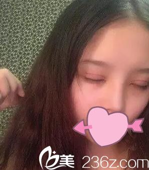 耿成虎做的雙眼皮術(shù)后一周 耿成虎做的雙眼皮術(shù)后一周