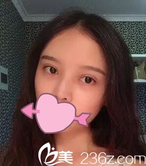 錦州斯美諾耿成虎做雙眼皮第十天 錦州斯美諾耿成虎做雙眼皮第十天