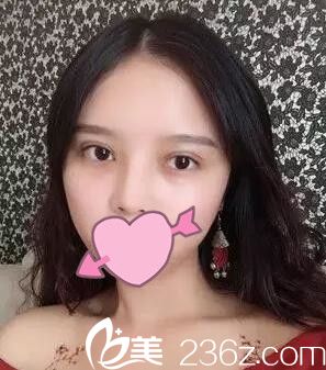 耿成虎做的雙眼皮半個(gè)月效果 耿成虎做的雙眼皮半個(gè)月效果