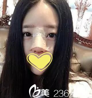 耿成虎鼻整形術(shù)后第二天 耿成虎鼻整形術(shù)后第二天