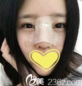 錦州斯美諾耿成虎鼻整形第六天 錦州斯美諾耿成虎鼻整形第六天