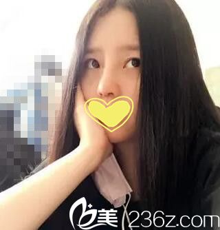 耿成虎鼻整形案例第十二天 耿成虎鼻整形案例第十二天