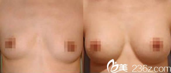 韓國瑞姿整形醫(yī)院崔載英院長隆胸案例圖