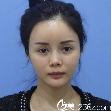 來(lái)廣州紫馨做隆鼻和脂肪填充前的照片 來(lái)廣州紫馨做隆鼻和脂肪填充前的照片