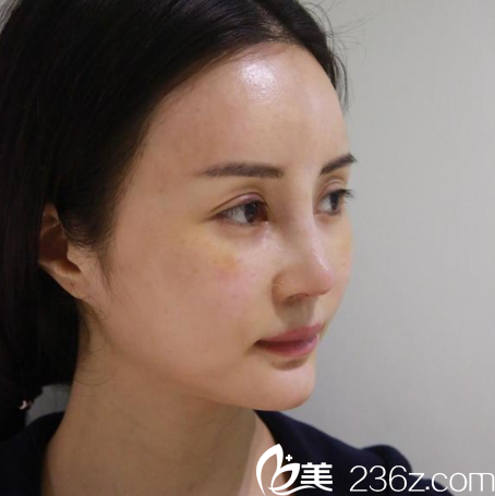 找廣州紫馨金孝憲院長(zhǎng)做完鼻綜合隆鼻七天效果圖 找廣州紫馨金孝憲院長(zhǎng)做完鼻綜合隆鼻七天效果圖