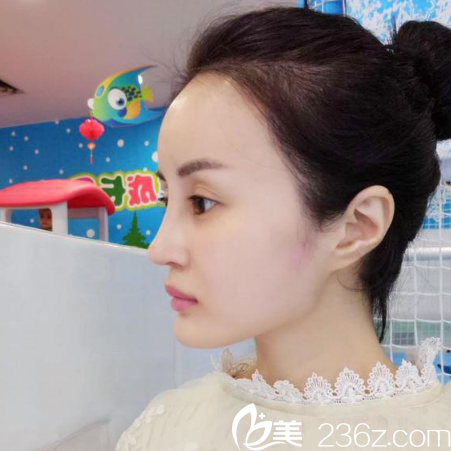 廣州紫馨金孝憲院長(zhǎng)為我做的隆鼻隆鼻和脂肪填充半個(gè)月自拍照片 廣州紫馨金孝憲院長(zhǎng)為我做的隆鼻隆鼻和脂肪填充半個(gè)月自拍照片