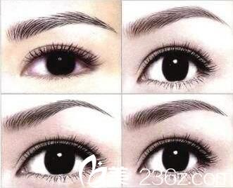 美萊美容醫(yī)院梁桂英文秀類型 美萊美容醫(yī)院梁桂英文秀類型