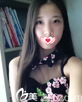 大家都感覺腫泡眼蛻變魅惑電眼非常難 但我找王金州做切開雙眼皮術(shù)后26天就實(shí)現(xiàn)了