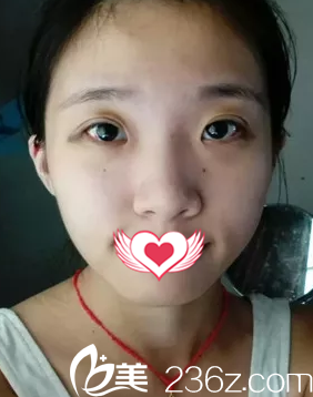 雙眼皮術(shù)18天后完全消腫 雙眼皮術(shù)18天后完全消腫