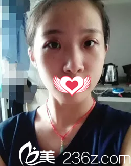 術(shù)后7天眼睛基本消腫 術(shù)后7天眼睛基本消腫