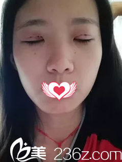 術(shù)后3天雙眼皮微腫 術(shù)后3天雙眼皮微腫