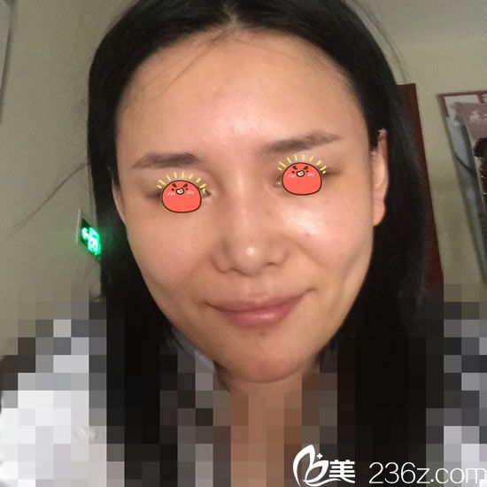 在寧波童顏?zhàn)鲎泽w脂肪填充前 在寧波童顏?zhàn)鲎泽w脂肪填充前