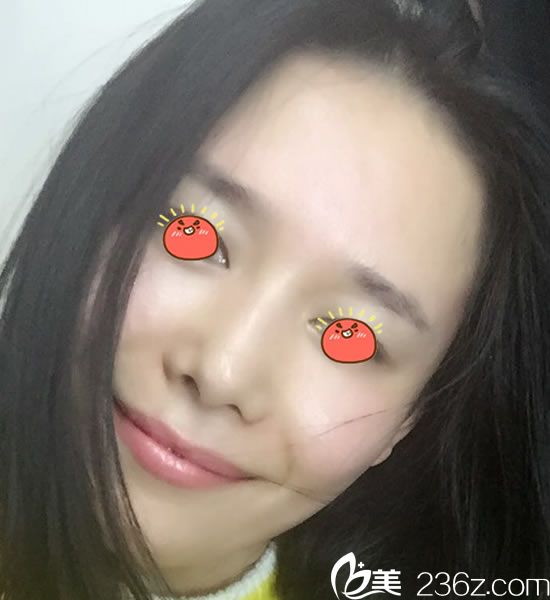 選擇寧波童顏?zhàn)鲋咎畛?個(gè)月后 選擇寧波童顏?zhàn)鲋咎畛?個(gè)月后