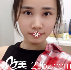 唐明芳雙眼皮術(shù)后12天