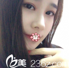 遵義利美康雙眼皮手術(shù)一個月效果