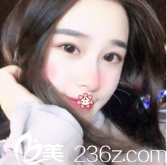 遵義利美康唐明芳雙眼皮案例