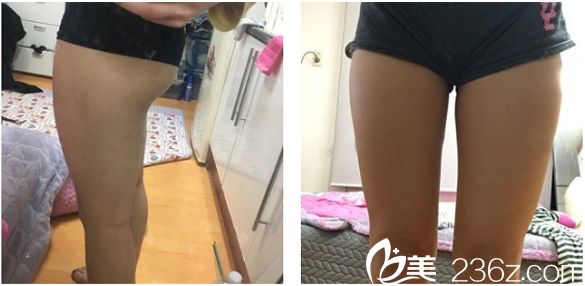 來廣州曙光整形醫(yī)院做大腿吸脂前的照片 來廣州曙光整形醫(yī)院做大腿吸脂前的照片