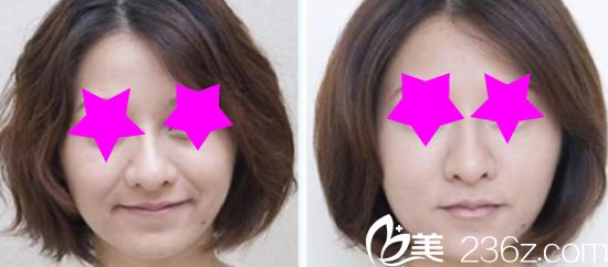 Channel整形醫(yī)院面部除皺前后效果