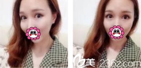 韓國黃金比雙眼皮做的好不好？看一個月前金明國為我做的韓式雙眼皮恢復圖