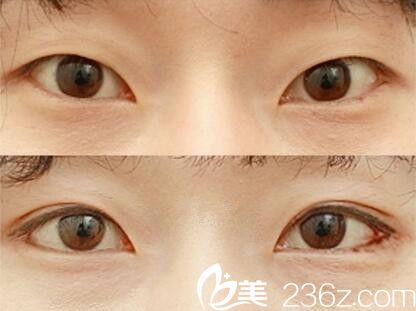 李重根眼綜合真人案例對比 李重根眼綜合真人案例對比