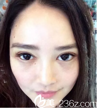 術(shù)后第10天我拆線了