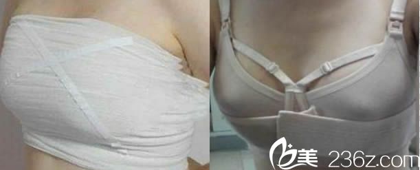 韓國(guó)瑞姿整形隆胸后穿塑胸內(nèi)衣圖