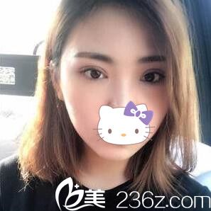 分享一個(gè)月前我在韓國(guó)美line整形醫(yī)院做雙眼皮的心路歷程及術(shù)后恢復(fù)效果圖