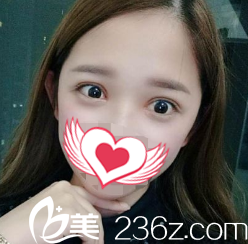 23天雙眼皮恢復(fù)款窄適中 23天雙眼皮恢復(fù)款窄適中