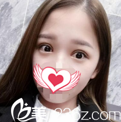 雙眼皮術(shù)后15天消腫 雙眼皮術(shù)后15天消腫