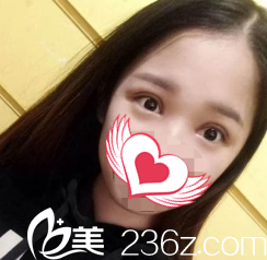 術(shù)后7天雙眼皮拆線后的樣子 術(shù)后7天雙眼皮拆線后的樣子