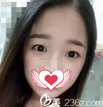 術(shù)前單眼皮 術(shù)前單眼皮