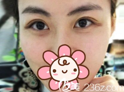 趁優(yōu)惠在張家港唯恩做了埋線法雙眼皮術(shù)后七天就基本恢復 閨蜜看了也準備割雙眼皮