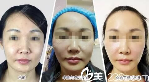 全面年輕化術(shù)后效果對(duì)比 全面年輕化術(shù)后效果對(duì)比