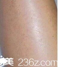 夏季不脫毛真的很傷悲 于是我選擇恩施天后做了冰點脫毛