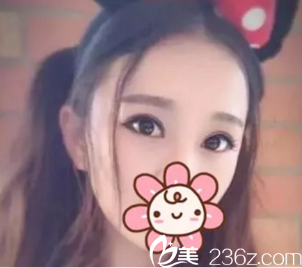 想知道在南寧芯玥做雙眼皮好嗎？分享我在南寧芯玥術(shù)后2月效果