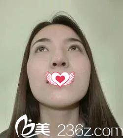 鼻綜合7天拆線后的樣子