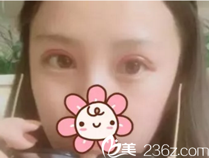 南寧美麗星做雙眼皮術(shù)后15天 南寧美麗星做雙眼皮術(shù)后15天