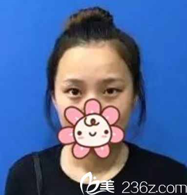 南寧美麗星做雙眼皮手術(shù)前 南寧美麗星做雙眼皮手術(shù)前