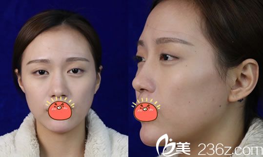 在寧波童顏做雙眼皮和隆鼻前 在寧波童顏做雙眼皮和隆鼻前