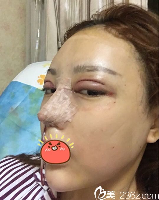 寧波童顏做雙眼皮和隆鼻即刻<span style= 寧波童顏做雙眼皮和隆鼻即刻<span style=